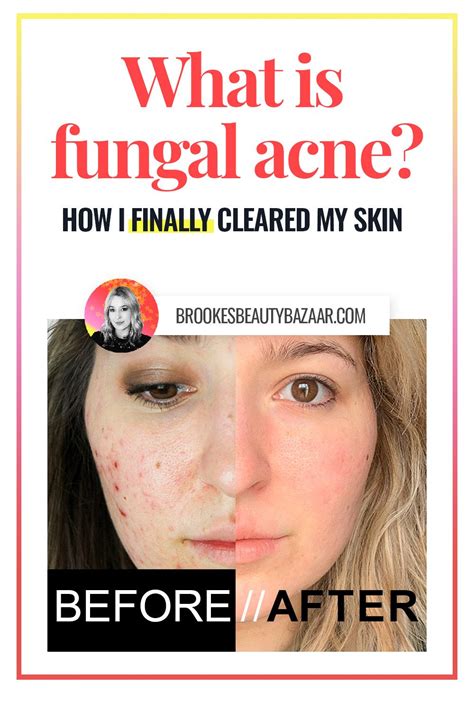 What Is Fungal Acne How To Identify It How To Get Rid Of It And Have