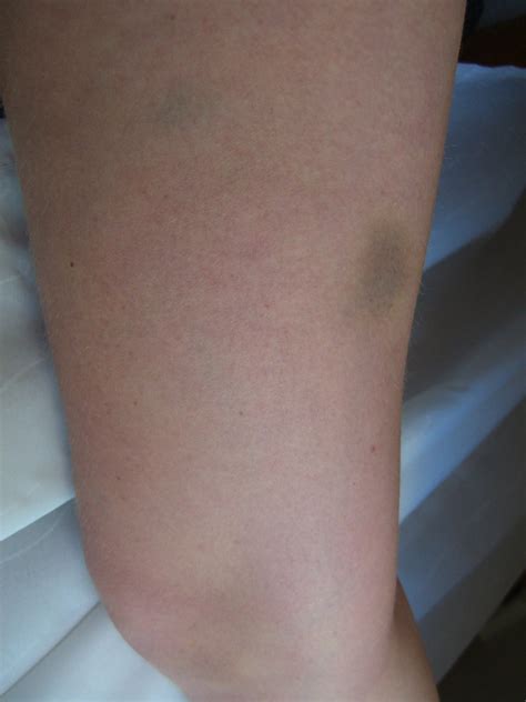 Right Thigh Bruises Ingrid Knutson Flickr