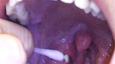 Tonsilloliths or tonsil stones are basically clusters of calcified material that form in our tonsils. Tonsil Stones Removal with Q-tips ♦ Treatment at home ...