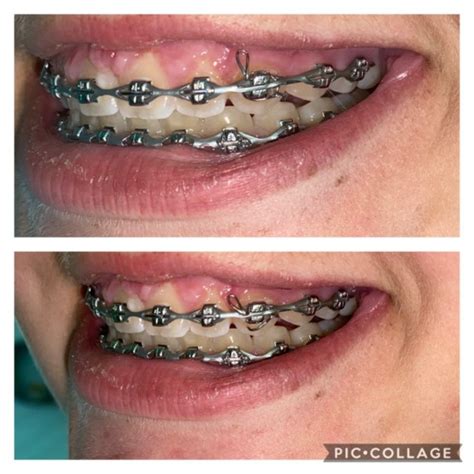 How does these rubber bands work? Dental Braces Frequently Asked Questions