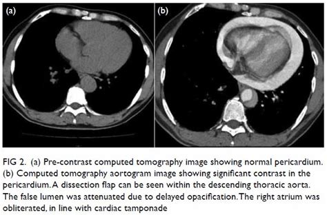 Sudden Cardiac Arrest With Pericardial Contrast During Computed