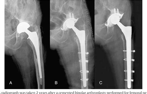 Clinical Results Of Conversion Total Hip Arthroplasty After Failed