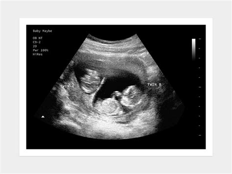 14 Weeks Pregnant With Twins Ultrasound