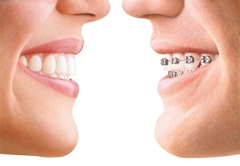 Ortodontia E Ortopedia Facial O Que é E Tipos De Tratamento Ortodontia Curitiba