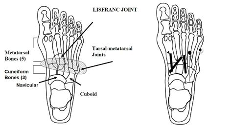 In a lisfranc joint injury, there is usually damage to the cartilage covering these bones. Lisfranc Foot Injuries & Treatment | Foot Surgeon in ...