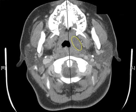 Cureus Bilateral Tonsillitis With Peritonsillar Abscess