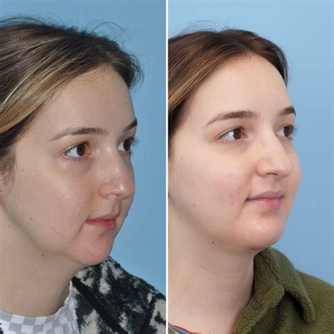 Patient 144687178 Chin Implant Before And After Photos Bloom Facial