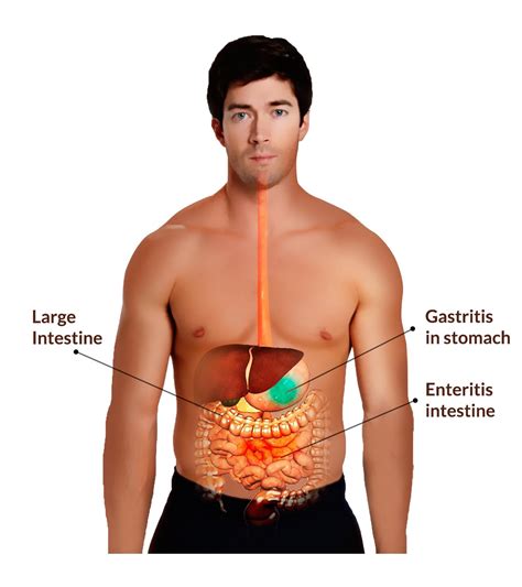 The burden of viral gastroenteritis in children living in rural china: Pin on Abdominal Pain