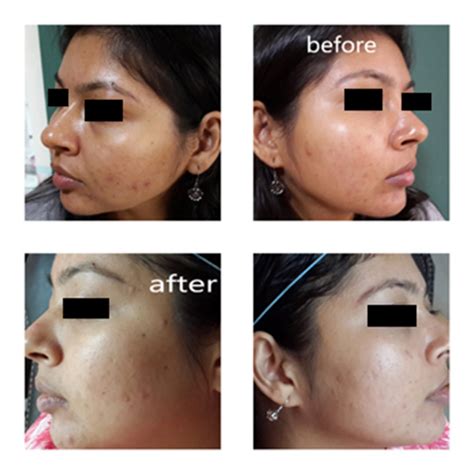 Before After Images Of Acne Treatment Orchid Cosmo Laser