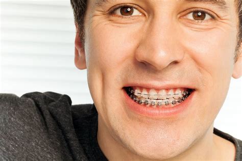 How Old Is Too Old For Braces And Orthodontic Treatment