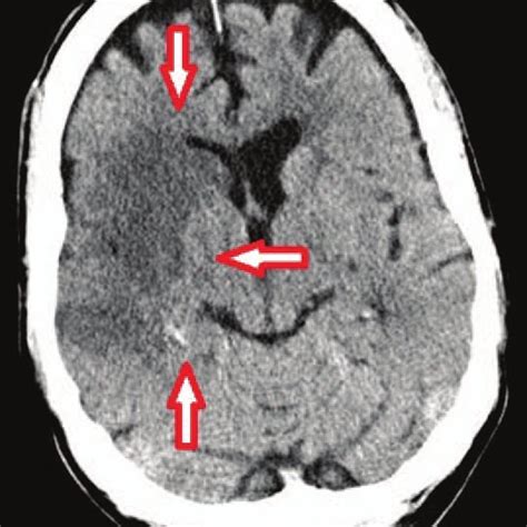 Cerebral Ct Scan Showing Right Hemispheric Stroke Hypoattenuating