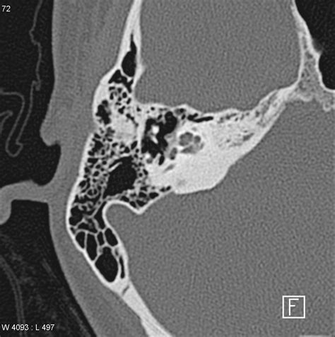 Retrofenestral Otosclerosis Image