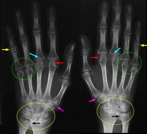 Rheumatoid Arthritis Hand X Ray