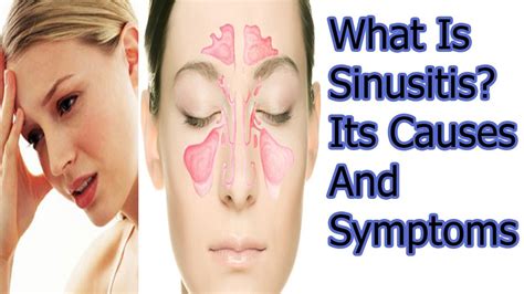 What Is Sinusitis Its Causes And Symptoms Youtube