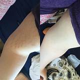 Pictures of Can Makeup Cover Up Stretch Marks
