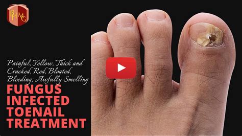 Toenail Fungus Podiatry