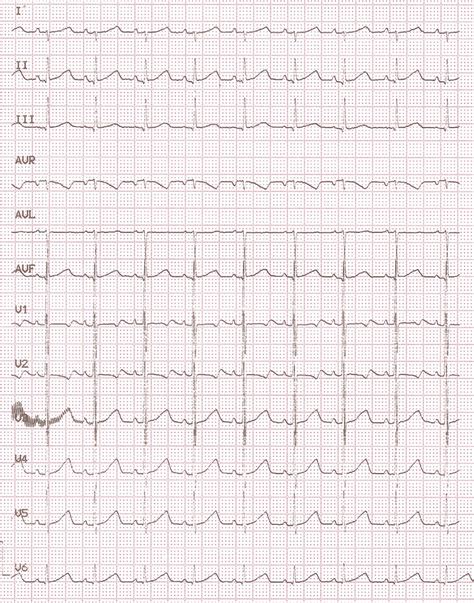 Electrocardiograma Realizado 2 H Tras La Cardioversión Mostrando Ritmo Download Scientific