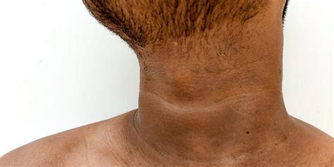 Dark Neck Symptoms Causes Treatment Cost And Tips To Avoid