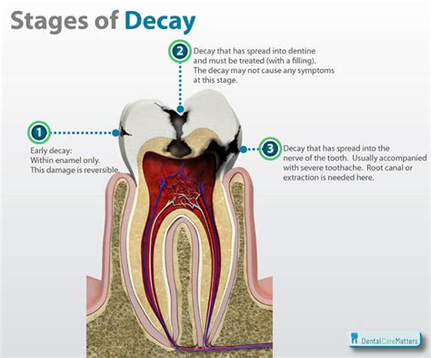 Tooth Decay Signs From Your Redcliffe Dentist John Street Dental