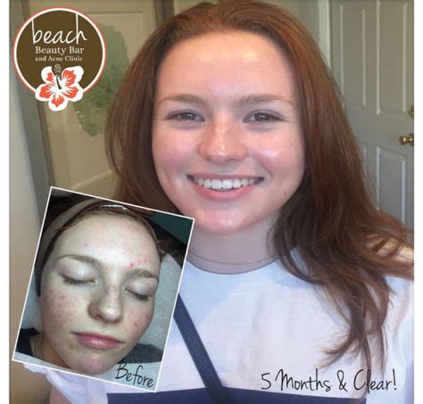 Acne Success Stories Beach Beauty Bar And Acne Clinic