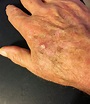 High Rates of Actinic Keratosis Lesion Recurrence, Even After Clearance ...