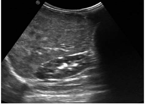 Abdominal Ultrasonography Showing Reduction In Liver Size And