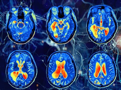 New Method Use Functional Magnetic Resonance Imaging Fmri To Diagnose