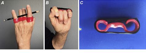 Figure 9 From Relative Motion Orthoses In The Management Of Various