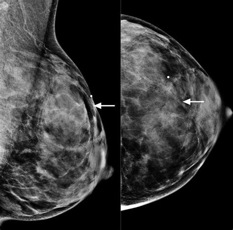 Mammographic Signs Of Systemic Disease Radiographics