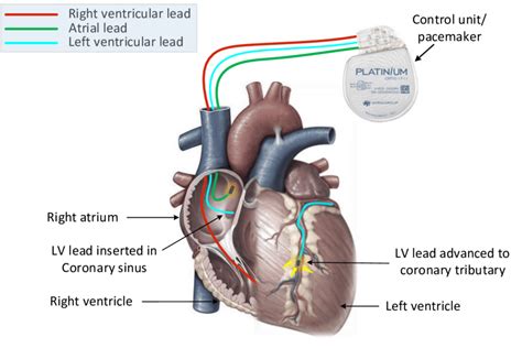 In Crt Or Biventricular Pacemaker A Left Ventricular Lead Is Implanted