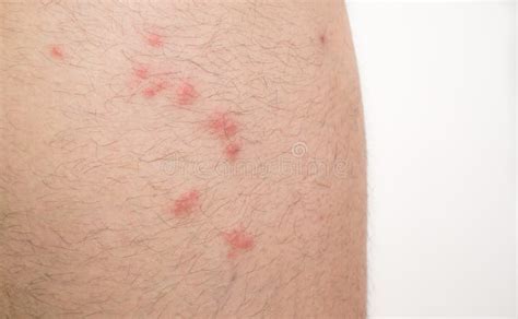 Flea Bites On Caucasian Man Leg Stock Image Image Of Irritated Itchy