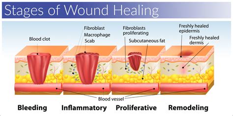 Stages Of Wound Healing Diagram Quizlet