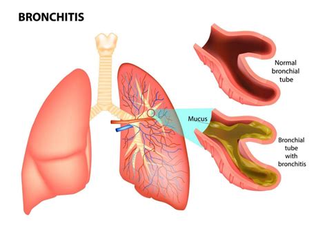 Bronquitis Causas S Ntomas Y Opciones De Tratamiento