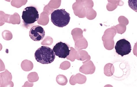 Cureus Acute Basophilic Leukemia Recent Molecular And Diagnostic Update