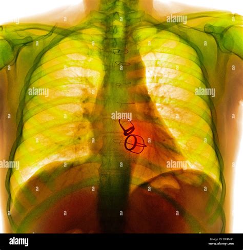 Human Heart X Ray Hi Res Stock Photography And Images Alamy