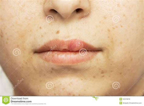 Herpes Oral Cold Sore Blisters On The Lips Herpes Simplex Stock Photo