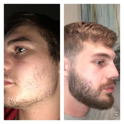 Most studies indicate that the results from minoxidil usually start to show after six months. Minoxidil Guide for Thicker Beard, Facial Hair and Fuller ...
