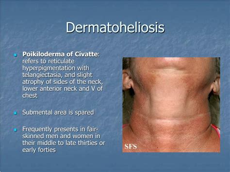 Ppt Dermatoses Resulting From Physical Factors Powerpoint