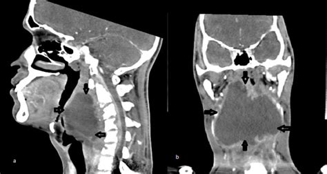 Retropharyngeal Tuberculosis Abscess A Case Report And Review Of The