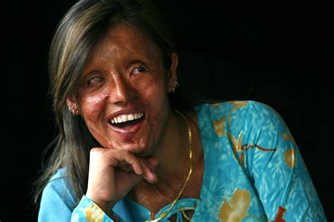 How To Help Acid Attack Victims Heal By Spreading Awareness And Acceptance