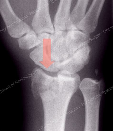 How To Avoid Complications Of A Distal Radius Fracture Broken Wrist