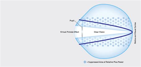 Vti Naturalvue Enhanced Multifocal Contact Lenses Neurofocus Optics