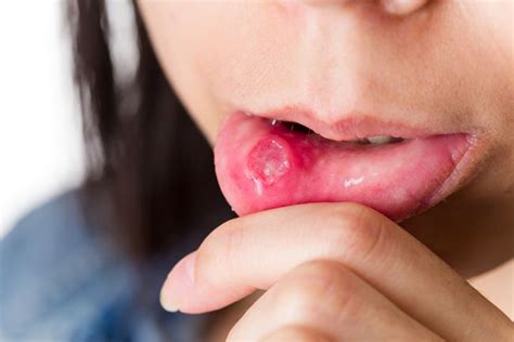 Identify The Cause Of Candidiasis Health Articles For Healthy Living