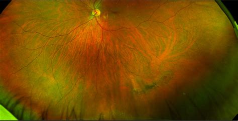 Sonoran Desert Eye Center Atrophic Retinal Hole Within Lattice