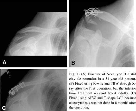 Figure 1 From Operative Treatment Of Distal Clavicle Fracture Nonunion