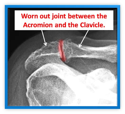 Acromioclavicular Joint Acj Injury Shoulder Conditions