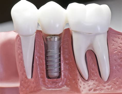 Dental Implant Placement Basics As A Step By Step Process General