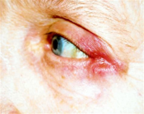 Sarcoidosis Presenting As A Cutaneous Eyelid Mass British Journal Of