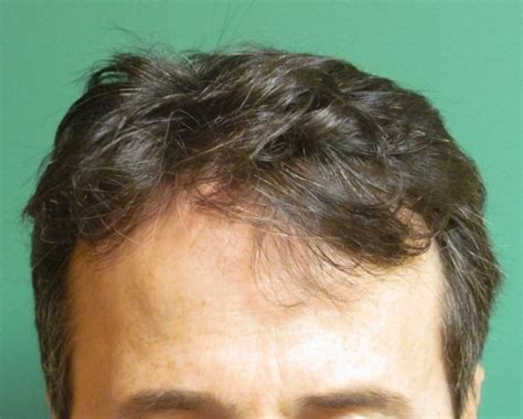 hair loss information chicago gold coast milwaukee oakbrook il
