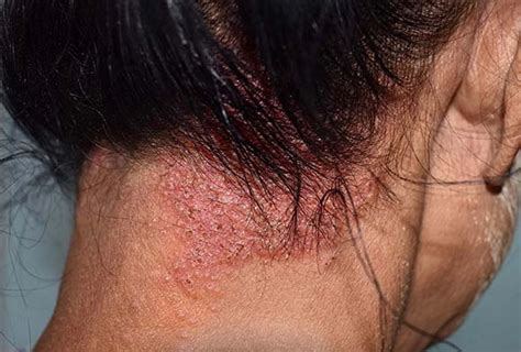 Best Scalp Infections Treatment In Bangalore Dr Health Hair Clinic